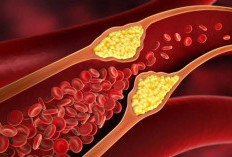Aman Dikonsumsi, ini 6 Obat Kolestrol yang Ampuh dan Harga Terjangkau