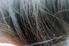 Kutu Rambut Menyerangmu, Ini 5 Obat Ampuh Membasminya