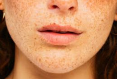 Apa Penyebab Bintik di Badan dan Bagaimana Penyembuhannya, Simak Disini