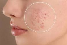 Tidak Hanya Serum Vitamin C, berikut 11 Metode Agar Jerawat Kabur Selamanya Dari Pipimu