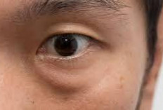 Penyebab dan Cara Mengatasi Kantung Mata