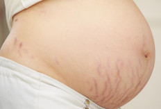 Stretch Mark! Yuk Cari Tahu Penyebab dan Cara Mencegahnya